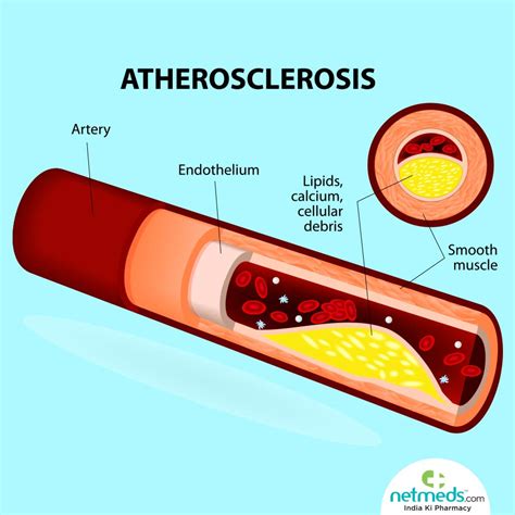 atherosclerotic aorta in tagalog|Atherosclerosis: Symptoms, Causes, Diagnosis, and Treatment.
